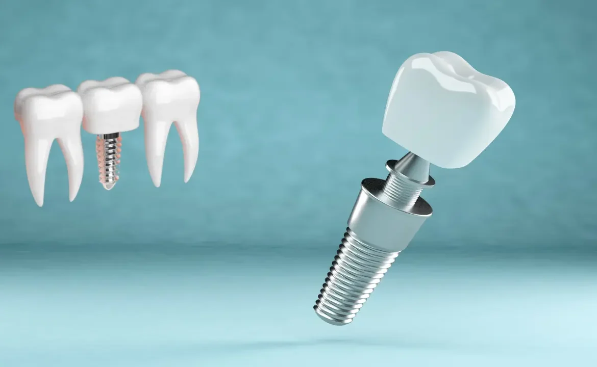 Dental Implants in Dubai