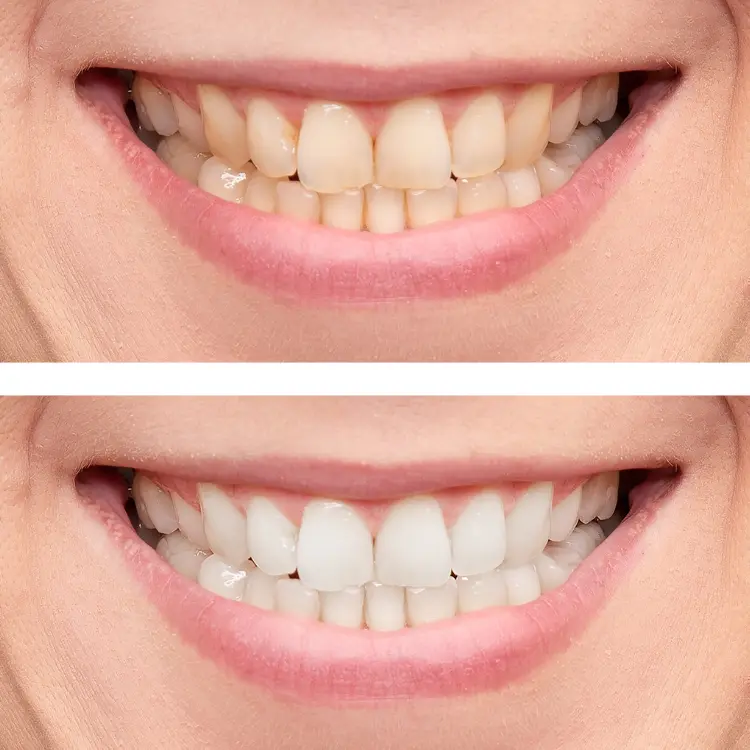 Different Teeth Whitening Options