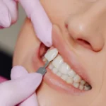 Everything You Need to Know Before Getting Dental Veneers